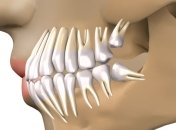 От зубов мудрости можно избавиться в детстве