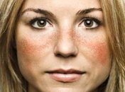 Названа причина, из-за которой женщины чаще мужчин болеют системной красной волчанкой