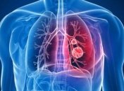 Ранние симптомы пневмонии, которые нельзя игнорировать