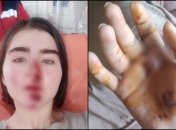 Киевлянка разбила лицо из-за отказа тормозов на самокате Bolt: подробности ЧП (фото)