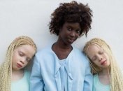 Темнокожие близнецы-альбиносы покорили своей неземной красотой (Фото) 