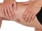 Синяки на теле без причины - это очень тревожный сигнал организма