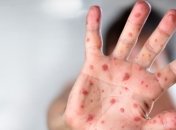 Корь атакует: за неделю заболели 3,5 тысячи украинцев