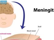 Жителям Буковины угрожает вирусный менингит из соседней Румынии