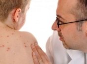 В Молдове введен "оранжевый" уровень опасности из-за кори