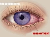 Доступное натуральное средство в помощь при конъюнктивите