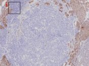 Исследователи остановили онкогенез у мышей