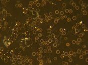 Поражает нос, глаза и мозг: выздоравливающие от COVID в Индии стали страдать от "черного грибка"