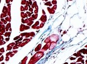 Патологии при волчанке связали с разрывом нейронов