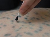 В Мариуполе - масштабная вспышка ветрянки