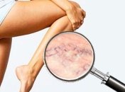 Варикоз: основные причины и лечение