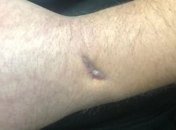 У военнопленного моряка Сороки обнаружили повреждение еще одной мышцы руки