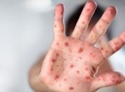 Вспышку кори зафиксировали в еще одной области