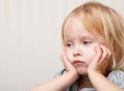 Корь в Украине: школьникам во Львове продлили каникулы