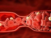 Разработан робот, который будет очищать сосуды от тромбов