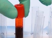 Уровень ТМАО в крови предскажет приближающуюся смерть