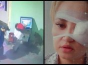 Собака едва не лишила глаза девушку в Крыму: момент происшествия попал на видео