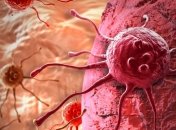 Онкологам США удалось уничтожить раковую опухоль на поздней стадии