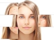 7 природных способов избавиться от пигментации