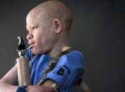 Дети в Танзании, страдающие альбинизмом, живут в постоянной опасности (Фото) 