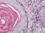 С помощью методов физики можно обнаружить раковые опухоли