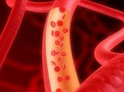 Медики сообщили: атеросклероз влияет на здоровье мозга 