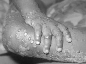 Жителей Европы начала поражать смертельно опасная инфекция: симптомы и фото