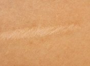 Ультразвук способствует лечению шрамов