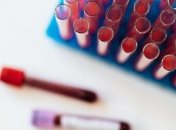 З анемією жарти погані: основні ознаки, які не можна ігнорувати