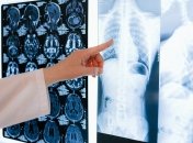 Коронавирус поражает легкие