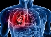 Первые признаки туберкулеза легких, которые нельзя игнорировать