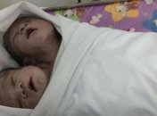 Уникальный случай: в Мьянме родился ребенок с двумя головами