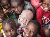 Чужой среди своих: как живут альбиносы в Танзании (Фото)