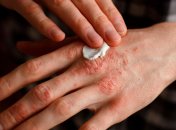 Улучшить состояние кожи помогут диета, витамины и алоэ