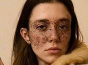 Веснушки по всему лицу не помешали этой девушке стать успешной моделью (Фото)