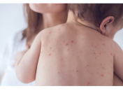 Корь у детей: симптомы, лечение, профилактика