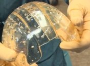 Ученые трансплантировали череп, напечатанный на 3D-принтере