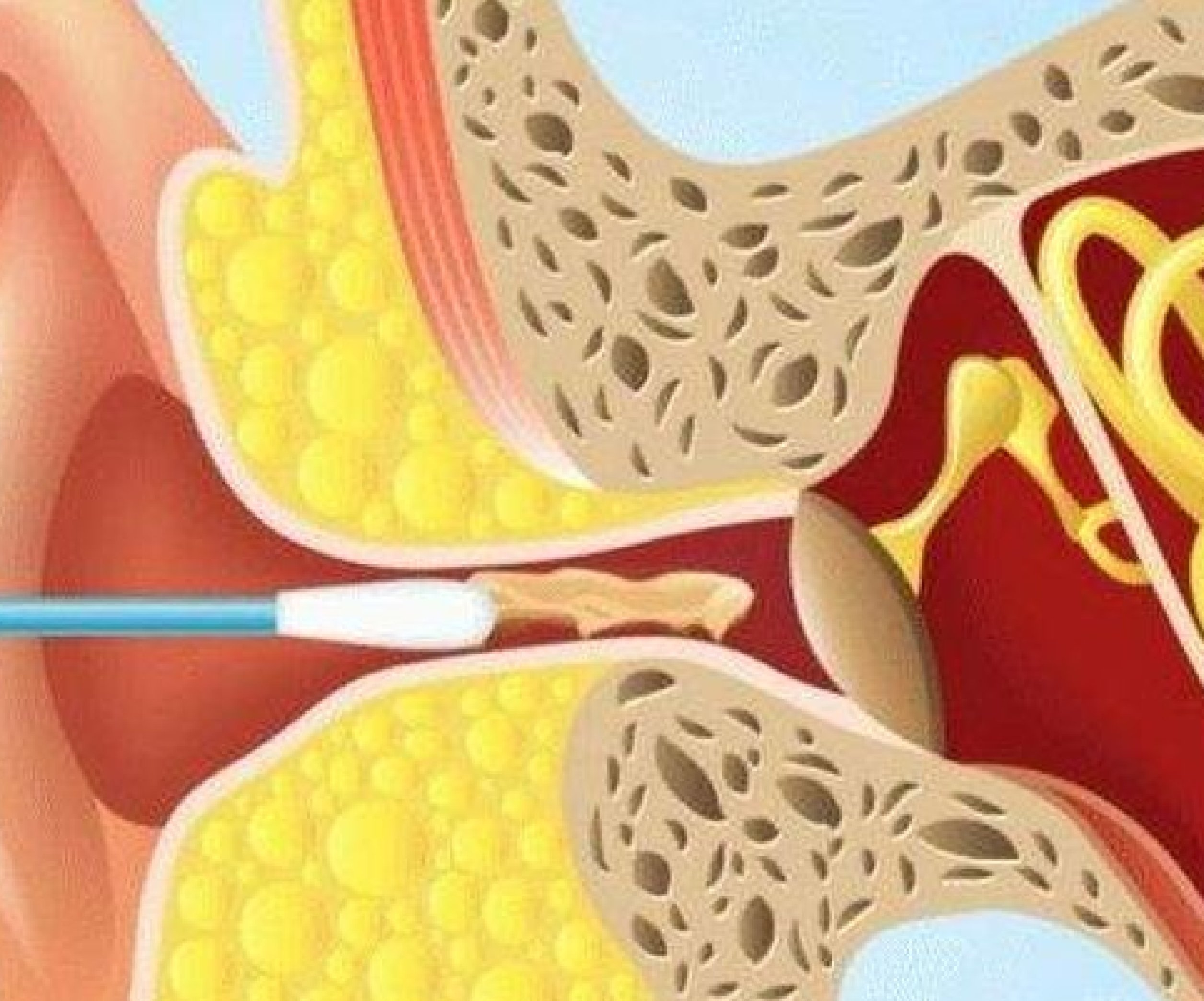 Почему считается, что нельзя чистить уши ватными палочками?