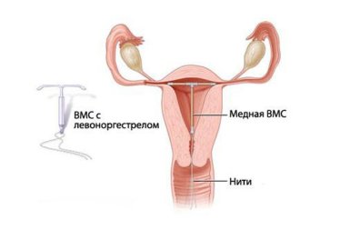 Отвечаем на 8 вопросов про спираль Мирена, которые вы стеснялись спросить