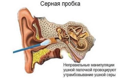 Как удалить серную пробку из уха ребенка и взрослого. Действия врача — клиника «Добробут»