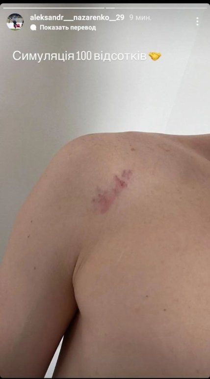 Пошкодження Олександра Назаренка у матчі з Олександрією