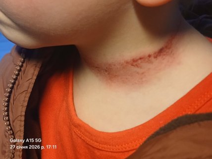 Такі сліди залишились на шиї в дитини