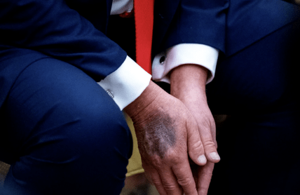 Синяк на руке Трампа