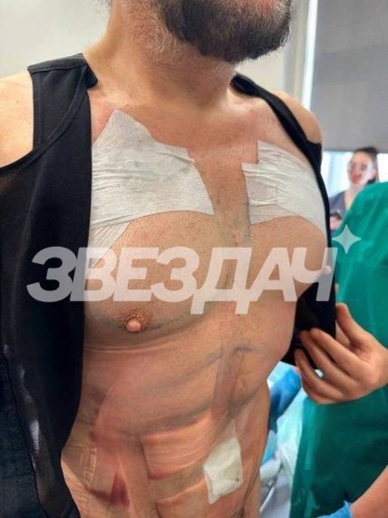 Киркоров после пластики