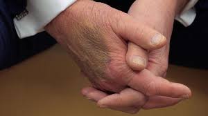 Трамп синець