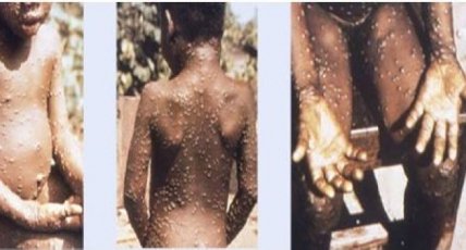 Оспа обезьян2