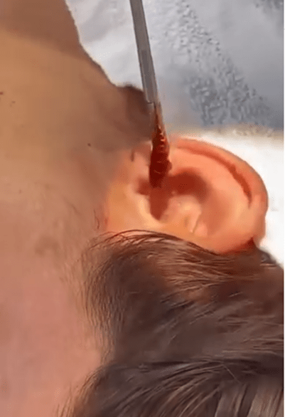 Таракана успешно достали из уха женщины