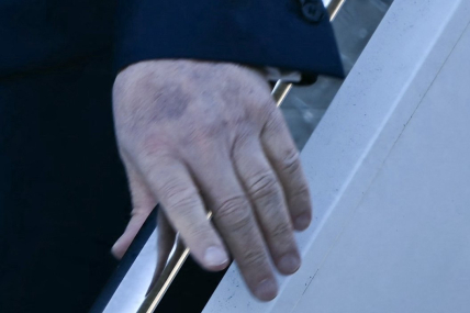 На правой руке Дональда Трампа заметили новый синяк