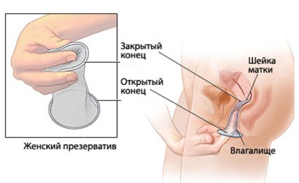 Женский презерватив как метод контрацепции: что нужно знать - изображение №1