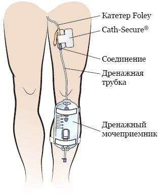 Катетер Фолея